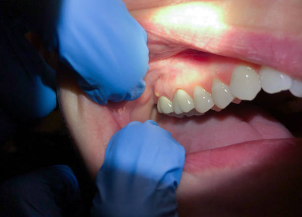 Best Emergency Root Canal Treatment in Riverview, SC